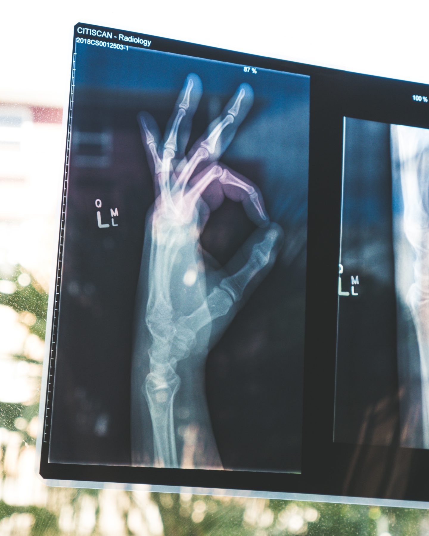 Image of an x-rayed hand giving the 'okay' sign 